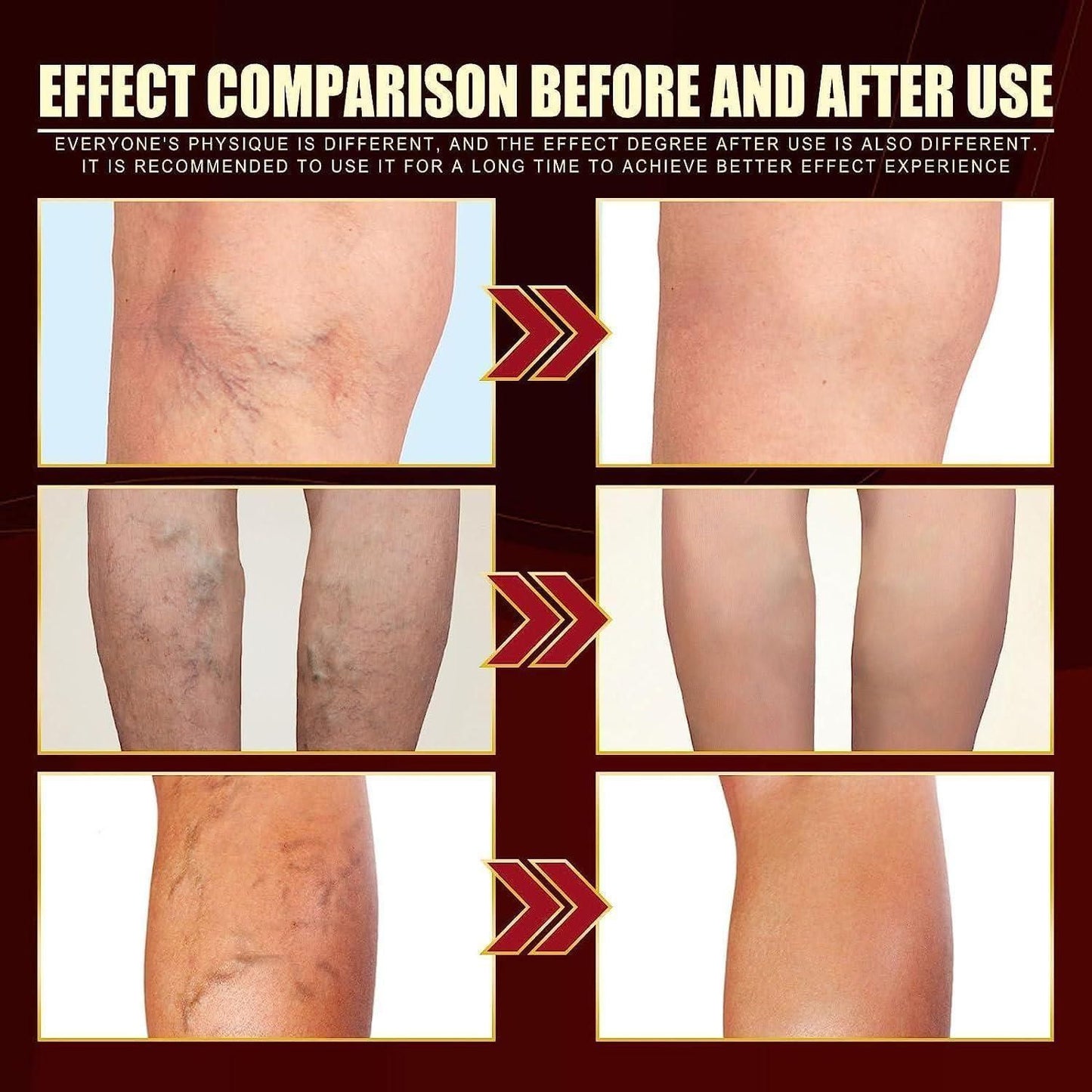 🩵 Vein Healing Varicose Veins Treatment Spray (Pack of 2)