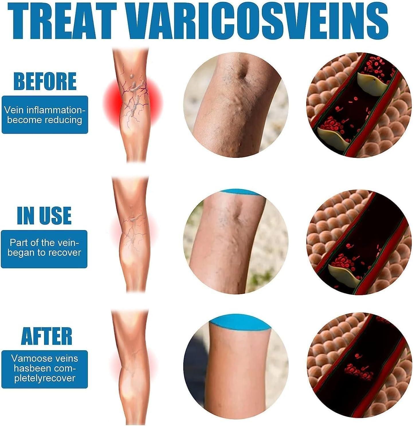 🩵 Vein Healing Varicose Veins Treatment Spray (Pack of 2)