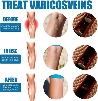 🩵 Vein Healing Varicose Veins Treatment Spray (Pack of 2)